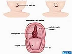 GELİŞİMSEL DİL VE KONUŞMA BOZUKLUĞU